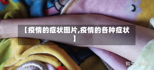【疫情的症状图片,疫情的各种症状】