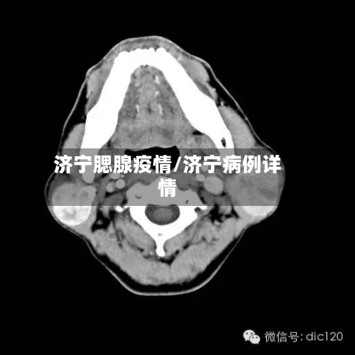 济宁腮腺疫情/济宁病例详情