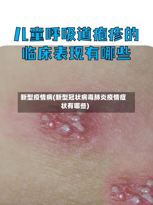 新型疫情病(新型冠状病毒肺炎疫情症状有哪些)-第3张图片